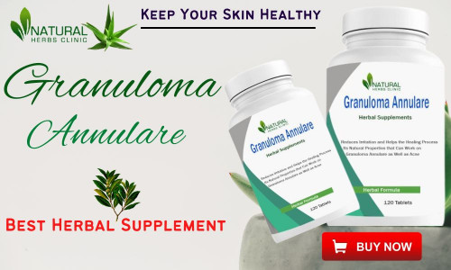 Here we will discuss five natural treatments that can help you to Get Rid of Granuloma Annulare Naturally. https://www.360postings.com/5-ways-to-get-rid-of-granuloma-annulare-naturally/