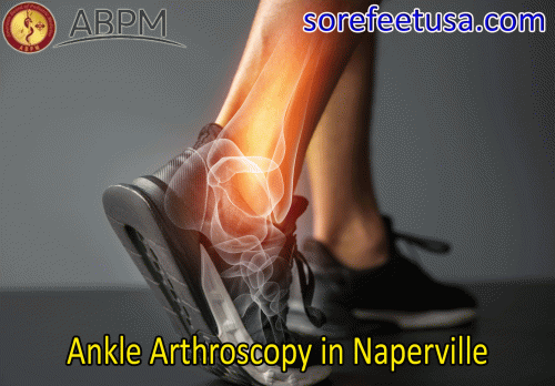 Ankle-Arthroscopy-in-Naperville.gif