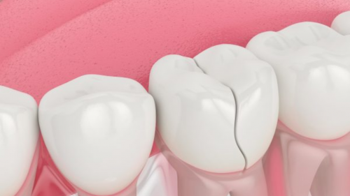 CÓ CHẮC BẠN ĐÃ HIỂU RÕ VỀ TRÁM RĂNG?
- Trám răng là kỹ thuật lấp đầy lỗ hổng của răng, áp dụng đối với răng sâu, răng thưa kẽ, răng bị sứt mẻ,...
- Thực hiện nhanh chóng, chỉ mất khoảng 15 - 20 phút cho mỗi lần trám
- Không xâm lấn răng thật do không cần mài răng hay làm mất mô răng 
- Không gây đau đớn, khó chịu trong quá trình trám
- Chi phí khá “hạt dẻ” so với các phương pháp nha khoa khác
- Tuy nhiên, kỹ thuật trám răng cũng tồn tại một số nhược điểm:
- Miếng trám có thể bong tróc khi nhai ăn nhai, độ bền tương đối
- Một số vật liệu trám răng có màu sắc không giống răng tự nhiên
- Hiện nay để khắc phục tình trạng răng sứt mẻ… thì làm răng sứ có thể nói là giải pháp phù hợp hơn trám răng rất nhiều nhờ việc sử dụng lâu và màu sắc cũng có thể chọn tương đương với răng thật.
- Đừng ngần ngại liên hệ ngay phòng khám nha khoa Big Dental để được miễn phí tư vấn trám răng bạn nhé! 
#nhakhoabigdental, #bigdental, #bigdentalcomvn, #phongkhamnhakhoa, #trongrangimplant, #niengrang, #dansuveneer, #niengrangmaccaisu, #niengranginvisalign
---------------------------------------------------------
Phòng khám nha khoa Big Dental - Hệ thống nha khoa uy tín hàng đầu.
Địa chỉ: 95C Đường Nguyễn Văn Thủ, Đa Kao, Quận 1, Thành phố Hồ Chí Minh
Google Map:
https://www.google.com/maps?cid=9887016865926696511
Xem thêm:
https://bigdental.com.vn/cay-ghep-implant-7-phut-khong-dau/