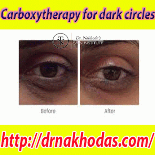 Carboxytherapy for dark circles