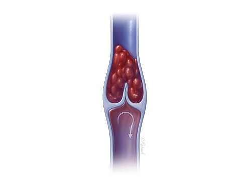 Deep-vein-thrombosis-DVT.jpg