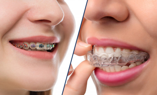 Invisalign-vs.-Braces.jpg