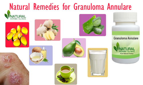 Milk of magnesia is precise of the decreased and suitable Natural Remedies for Granuloma Annulare additionally along with aggravating acne. You can use it on your affected pores and skin with a fiber ball, then permitting it to dry earlier than rinsing it off... https://naturalherbsclinic.hatenablog.com/entry/Natural_Remedies_for_Granuloma_Annulare