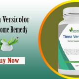 Natural-Remedies-for-Tinea-Versicolor