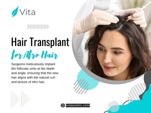 Choosing a clinic with expertise in Hair transplant for afro hair is paramount. Surgeons who specialize in working with Afro-textured hair bring a nuanced understanding of the unique needs of these curls. Their expertise ensures that the hair transplant process preserves the natural curl pattern, providing results that are not just aesthetically pleasing but also culturally authentic.

Official Website: https://vitaestetic.com/

Click here for More Information: https://vitaestetic.com/afro-hair-transplant-in-turkey/

Call Us: +90 544 363 39 91

Our Profile: https://gifyu.com/vitaestetic

More Photos: 

http://tinyurl.com/3hftnsjf
http://tinyurl.com/2bet9zr4
http://tinyurl.com/2844lpzx
http://tinyurl.com/2dktwgfj