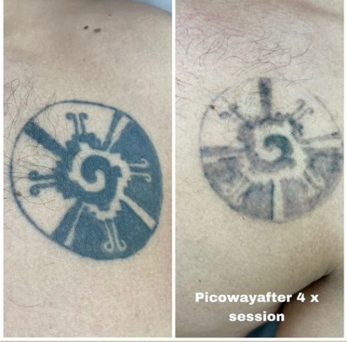 We’d like to share our side-by-side work in progress to illustrate that tattoo removal is a gradual process. Our commitment extends beyond achieving a tattoo-free result; we’re dedicated to leaving your skin flawless. These in-progress photos offer insight into the typical 10-12 treatment journey. To gain a deeper understanding of the removal process, schedule a complimentary consultation via the link in our bio. Read more: https://cosmetictattooingmelbourne.com.au/services/picoway-laser-skin-treatments/

#picowayskinlasertreatmentmelbourne #picowayskinlasertreatments #CosmeticTattooingMelbourne #cosmetictattooing