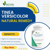 Tinea-Versicolor-Natural-Remediesb75f4001258b8ff0