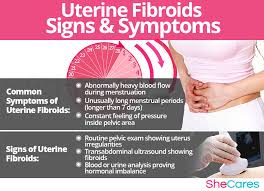 Uterine-Fibroid.jpg