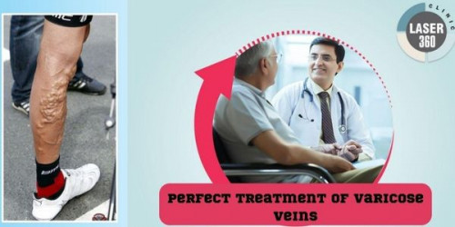 The perfect varicose vein laser treatment must be availed at the earliest without any ignorance for avoiding any further issues.
https://laser360clinic.com/varicose-veins-treatments-and-home-remedies/